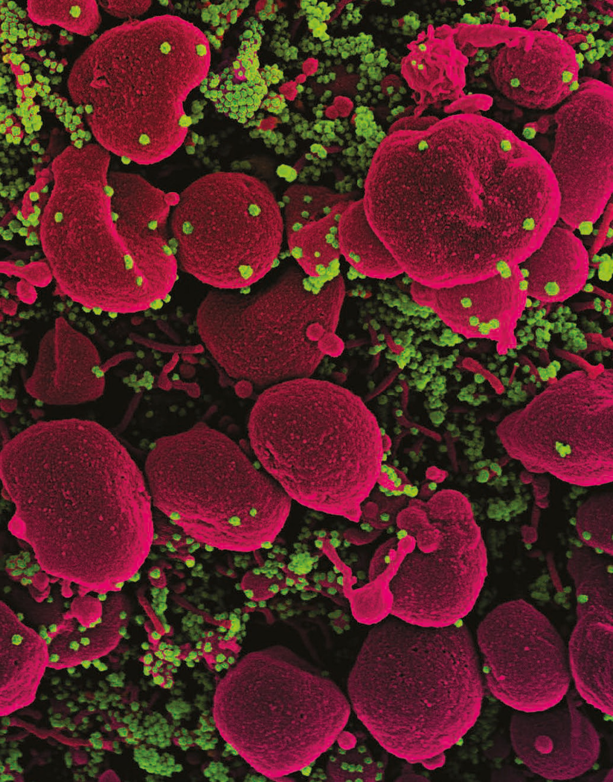 Ilustração de uma célula (vermelha) sendo atacada pelo vírus SARS-COV2 (verde)
