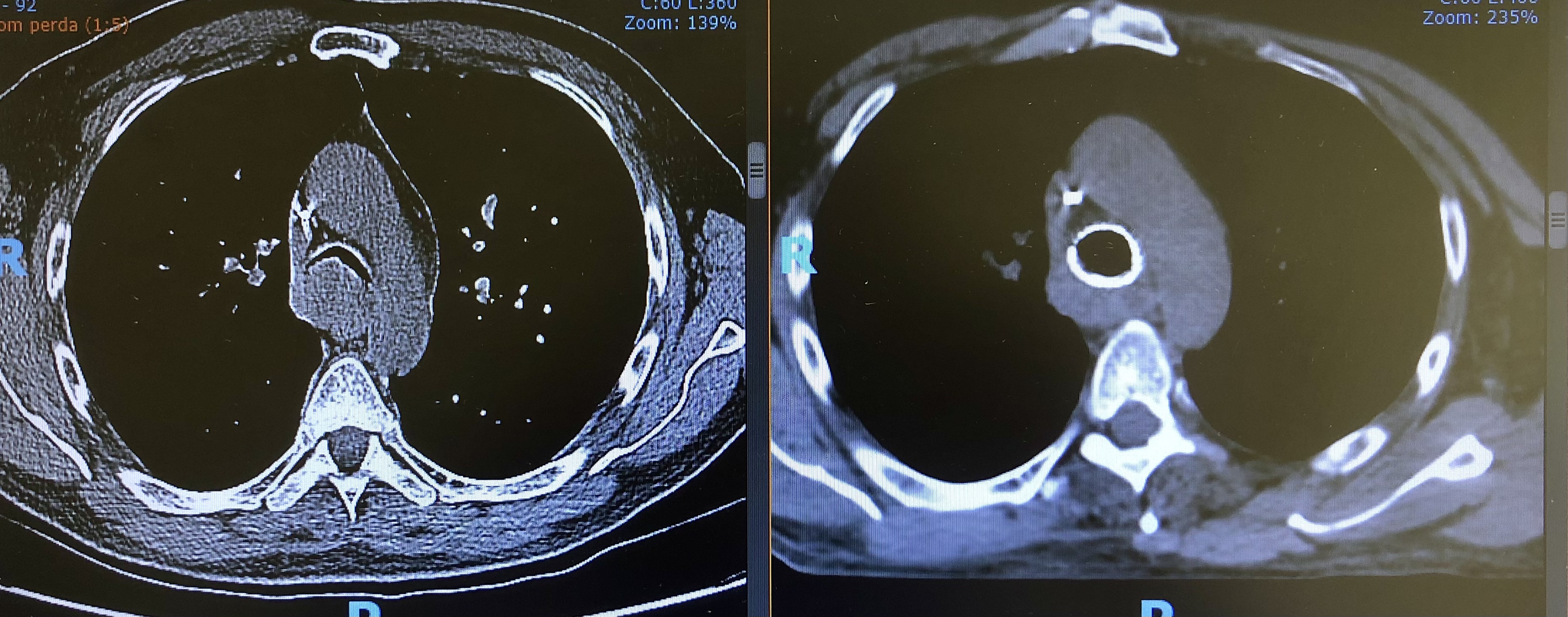 A imagem de tomografia à esquerda mostra que a traqueia do paciente estava quase fechada. A imagem à direita mostra a traqueia aberta após colocar uma prótese em um procedimento de broncoscopia intervencionista.
