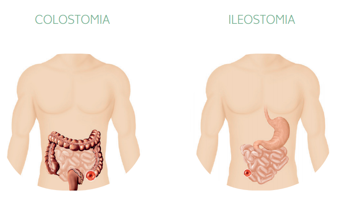 Colostomia e ileostomia