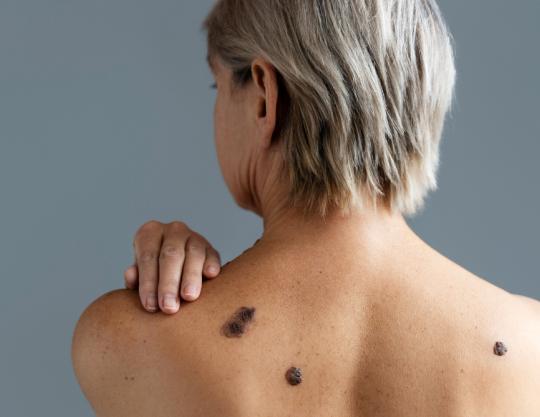 Do Melanócito ao Melanoma: Diagnóstico e Abordagens Integradas