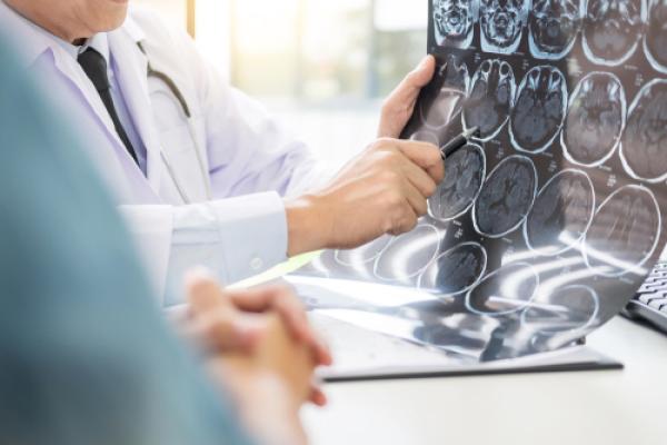 Tumores cerebrais tenha atenção aos sinais e sintomas