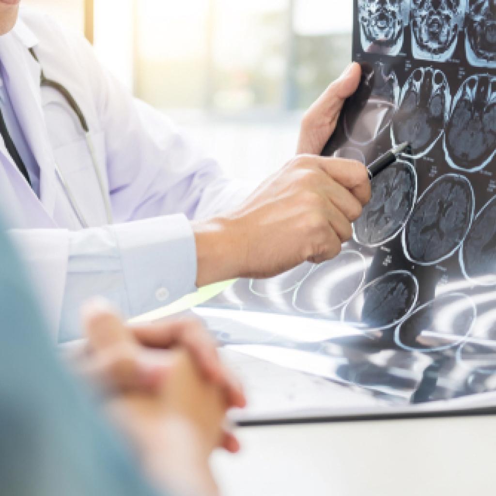 Tumores cerebrais tenha atenção aos sinais e sintomas
