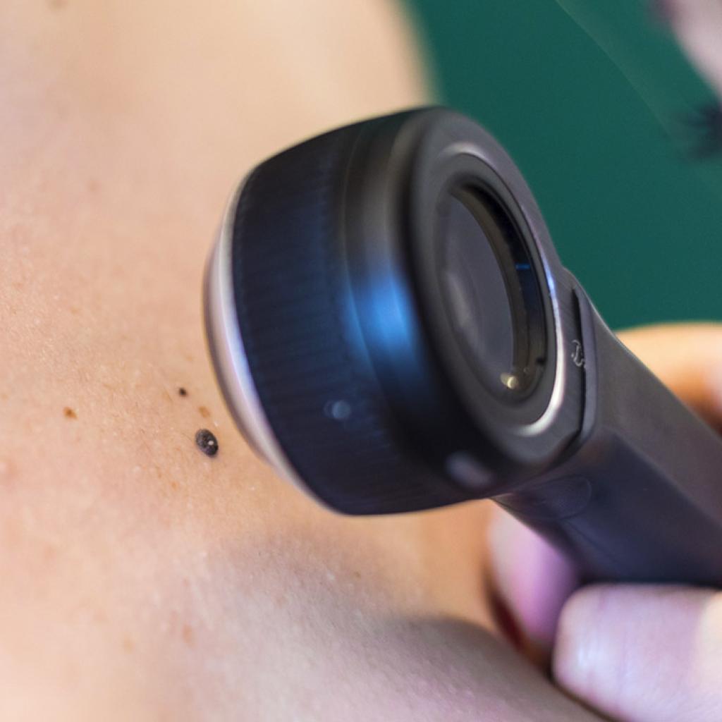 Médico analisando um pinta com um dermatoscópio